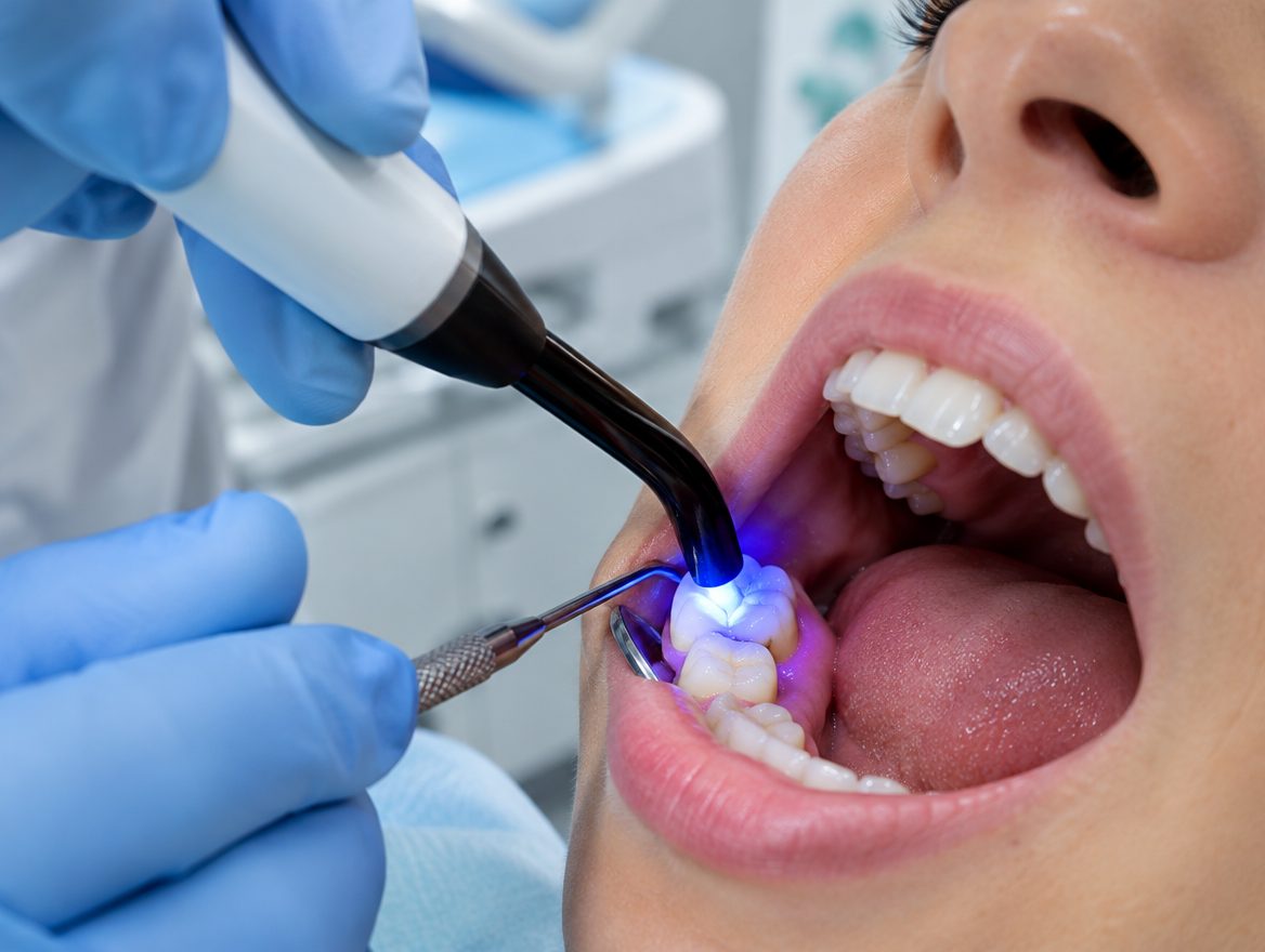 Diş Dolgusu - DENTİNOL Konya